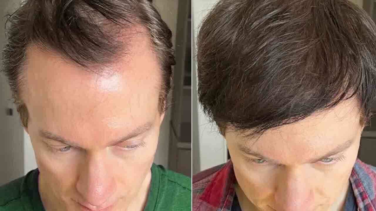 బట్టతల భాగ్యవంతులకు శుభవార్త.. 47 ఏళ్ల వయసులోనూ జుట్టు.. టెక్ మిలియనీర్ బ్రయాన్ జాన్సన్ సంచలనం