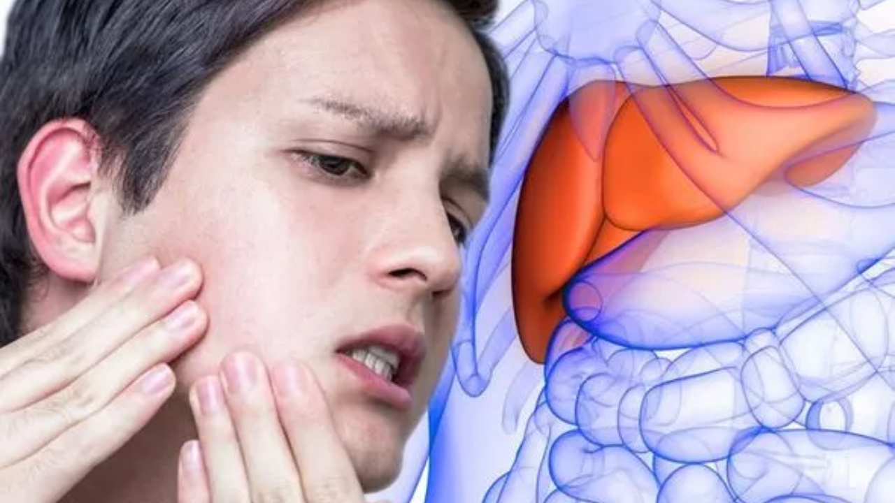  Fatty Liver:  మీ ముఖంలో ఈ మార్పులు కనిపించాయా.. అయితే ఫ్యాటీ లివర్ వ్యాధి వచ్చే అవకాశం