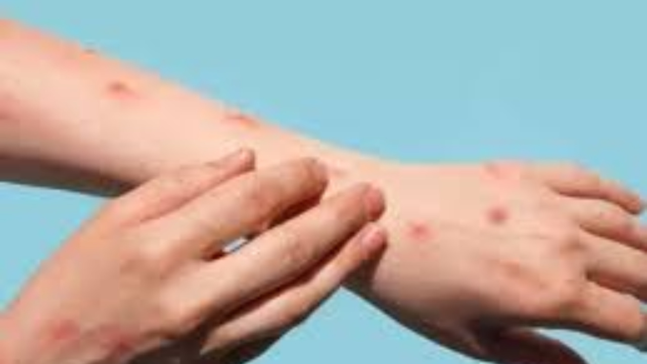 Monkeypox:  మంకీపాక్స్ వచ్చేసింది.. అప్రమత్తంగా ఉండాల్సిందే..భారత్‎లో అనుమానిత కేసు 