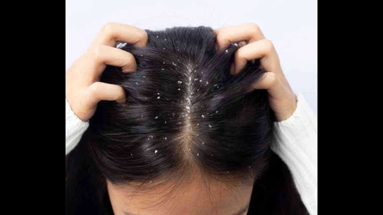 Dandruff : చుండ్రు సమస్యకు చెక్ పెట్టే సూపర్ హోం రెమెడీస్ మీకోసం