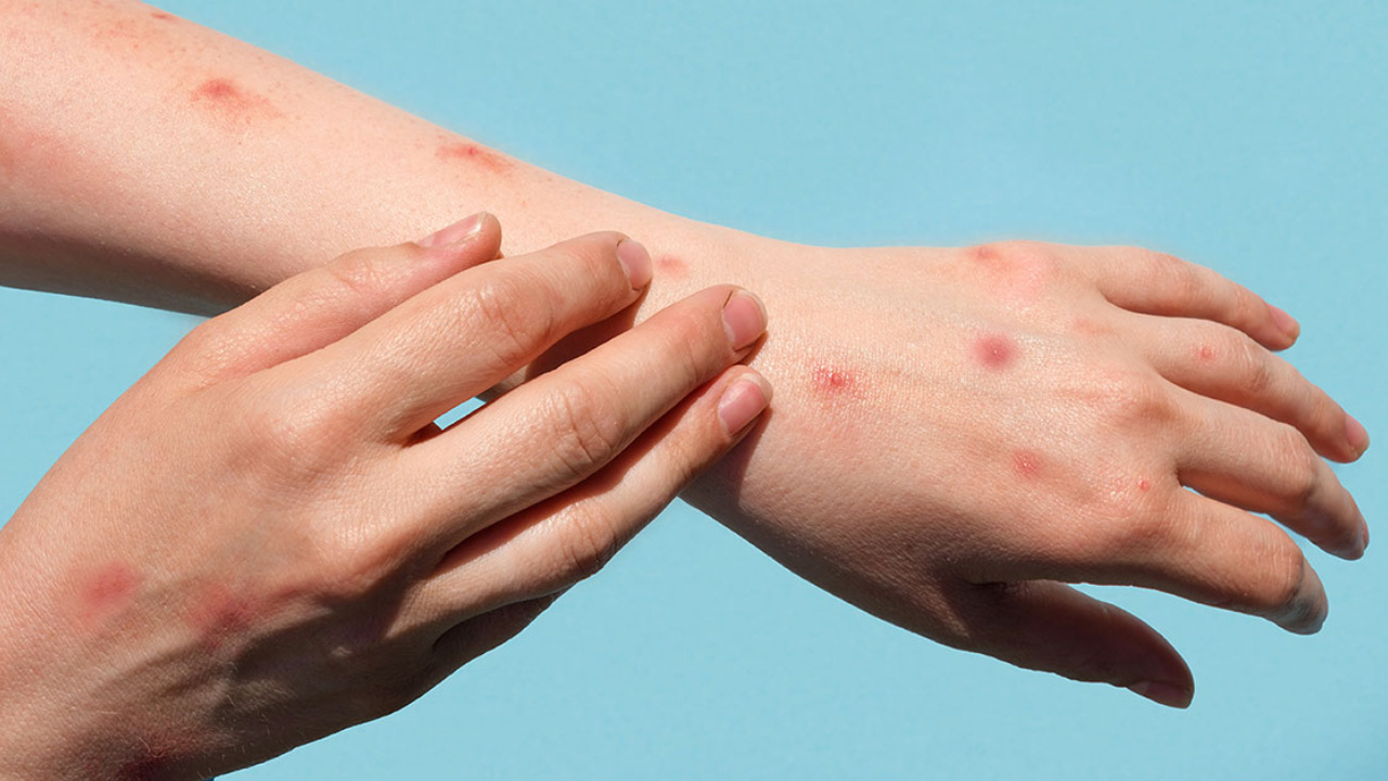 monkey pox: మంకీ పాక్స్ పిల్లలకు సోకే చాన్స్ ఎక్కువ..తీసుకోవాల్సిన జాగ్రత్తలు ఇవే