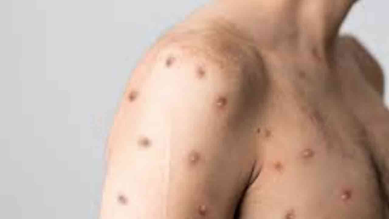 మంకీ ఫాక్స్ పై కేంద్రం అలర్ట్.. అప్రమత్తంగా ఉండాలని రాష్ట్రాలకు ఆదేశం 